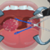 Tonsil Surgery